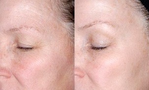 ādas atjaunošana ap acīm pirms un pēc fotogrāfijām