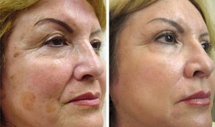 frakcionēta ādas atjaunošana pirms un pēc fotogrāfijām