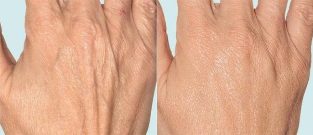 Roku āda pirms un pēc frakcionētas terapijas
