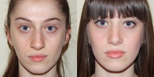 pirms un pēc plazmas ādas atjaunošanas